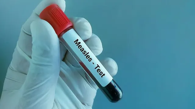 Measles Outbreak in Manipur Senapati: What’s Happening and How to Respond